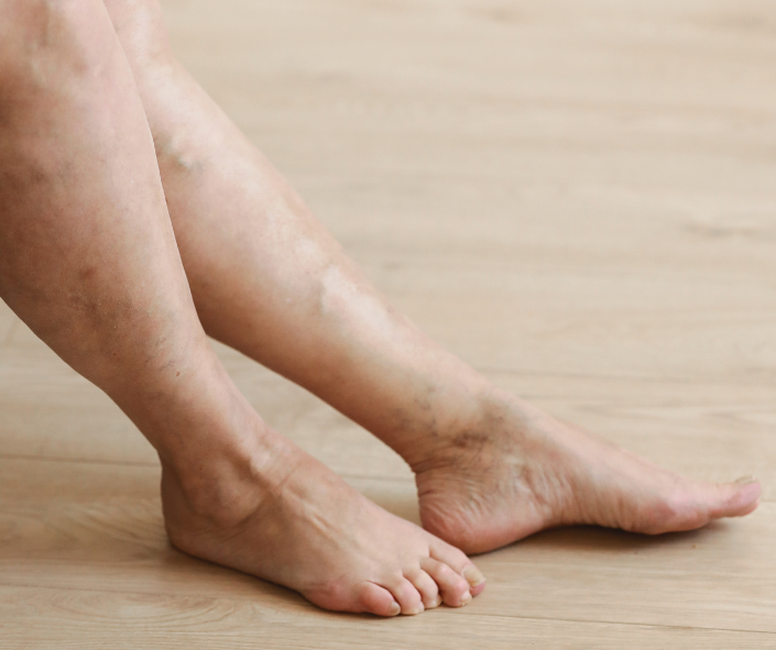 Varicose Veins under ICD-10